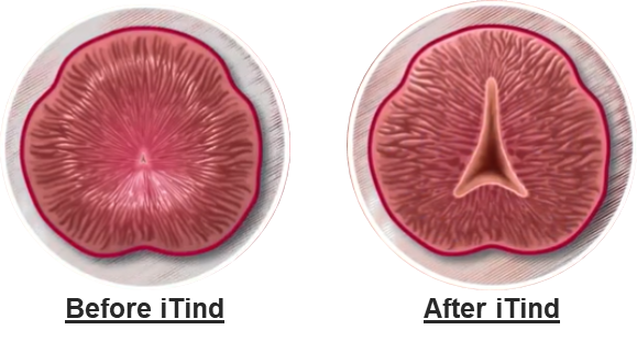 Stages of the iTind procedure